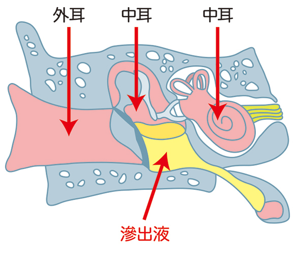 滲出性中耳炎とは