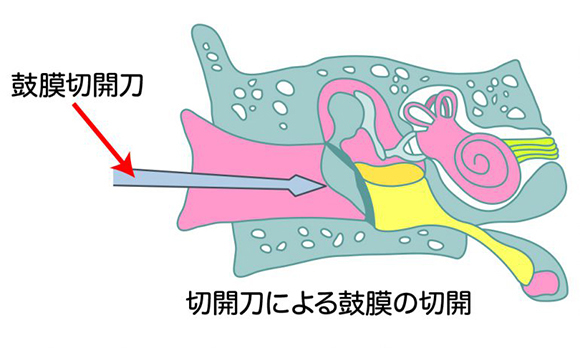 鼓膜切開術（外来手術）