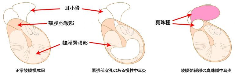 慢性中耳炎とは