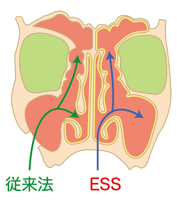 ESS（内視鏡下副鼻腔手術）