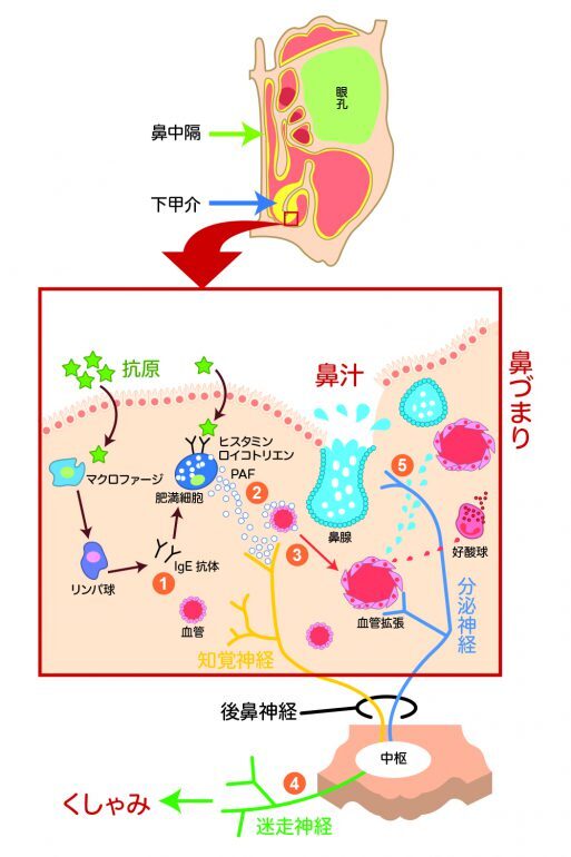 アレルギー性鼻炎の発症メカニズム